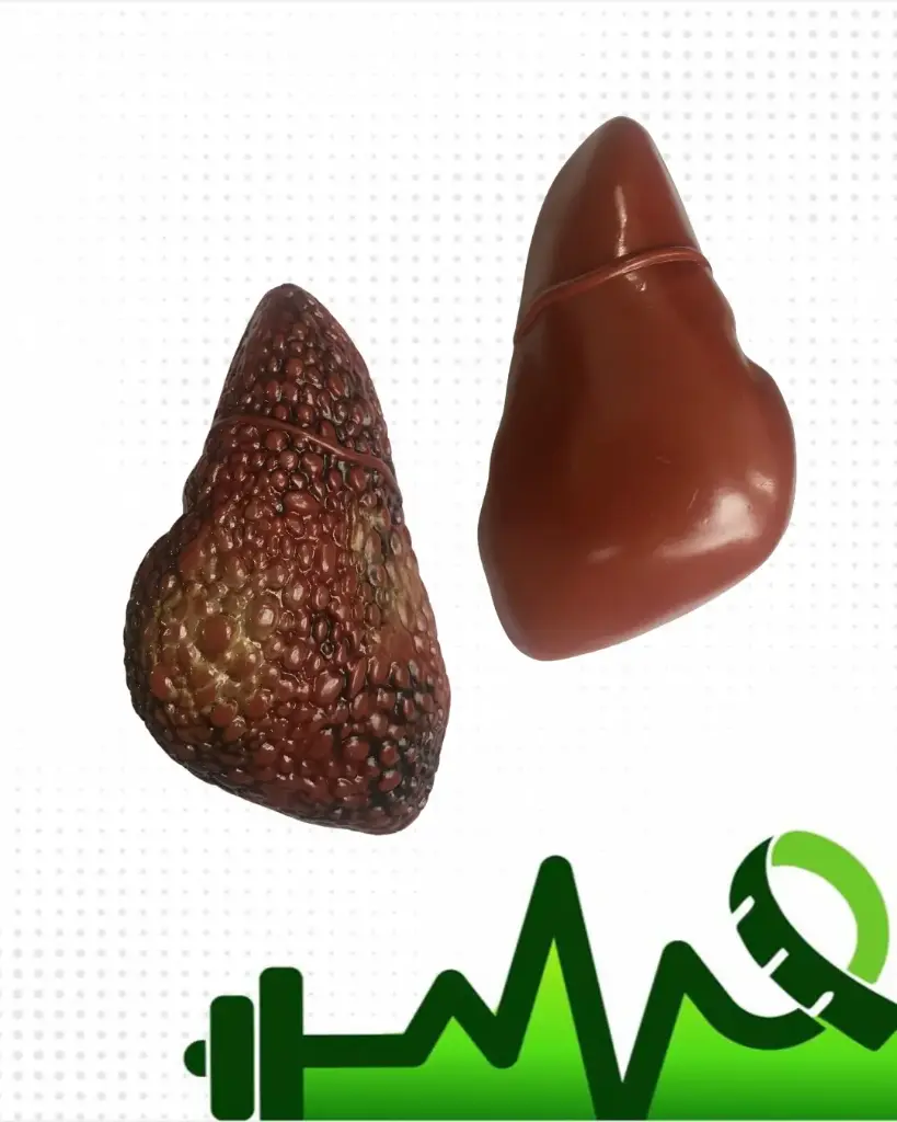 Esteatosis Hépatica