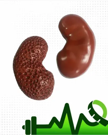 [MNF] Nefropatía diabética