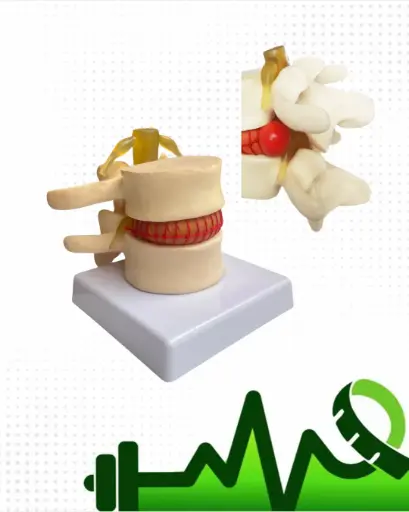 Modulo hernia discal